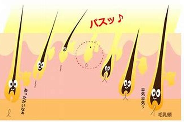 ハイパースキンカレンメカニズム